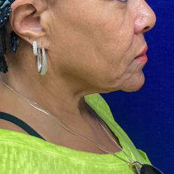 Neck Lift Before & After Patient #10473