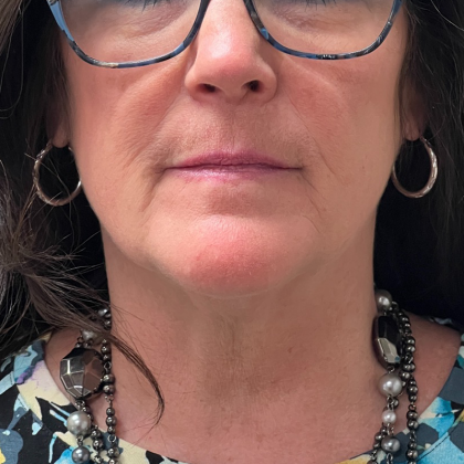 Neck Lift Before & After Patient #10467
