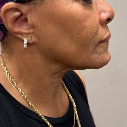 Neck Lift Before & After Patient #10473
