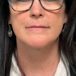 Neck Lift Before & After Patient #10467