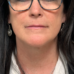 Neck Lift Before & After Patient #10467