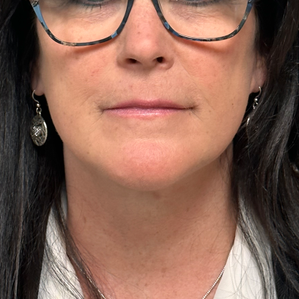 Neck Lift Before & After Patient #10467