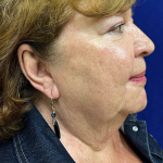 HourLift Before & After Patient #10506