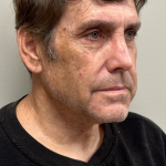 HourLift Before & After Patient #10500