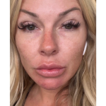 Revanesse Versa - Lips Before & After Patient #10513