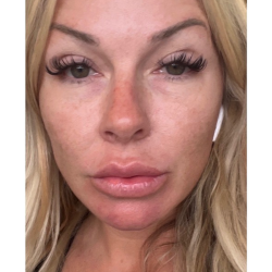 HourLift Before & After Patient #10513