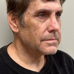 HourLift Before & After Patient #10500