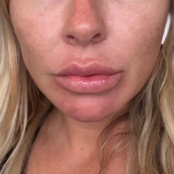 Neck Lift Before & After Patient #10518