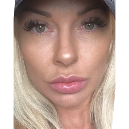 HourLift Before & After Patient #10513