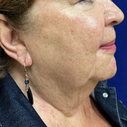 Neck Liposuction Before & After Patient #10512