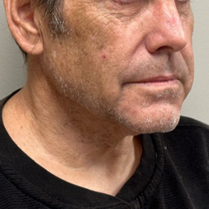 Neck Lift Before & After Patient #10505