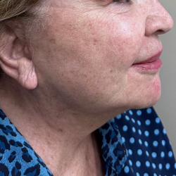 Neck Liposuction Before & After Patient #10512