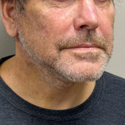 Neck Lift Before & After Patient #10505