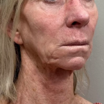 Neck Lift Before & After Patient #10551
