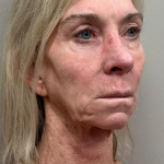 HourLift Before & After Patient #10546