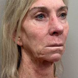 HourLift Before & After Patient #10546
