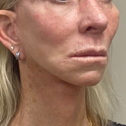 Neck Lift Before & After Patient #10551
