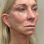 HourLift Before & After Patient #10546
