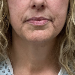 Neck Lift Before & After Patient #10561