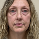 HourLift Before & After Patient #10556