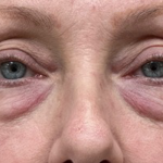 Blepharoplasty Before & After Patient #10564
