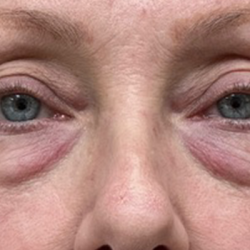Blepharoplasty Before & After Patient #10564