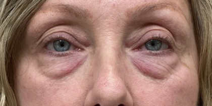 Blepharoplasty Before & After Patient #10564