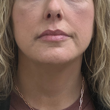 Neck Lift Before & After Patient #10561