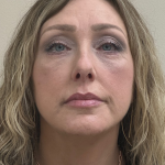 HourLift Before & After Patient #10556