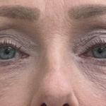 Blepharoplasty Before & After Patient #10564