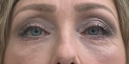 Blepharoplasty Before & After Patient #10564