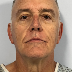 HourLift Before & After Patient #10582