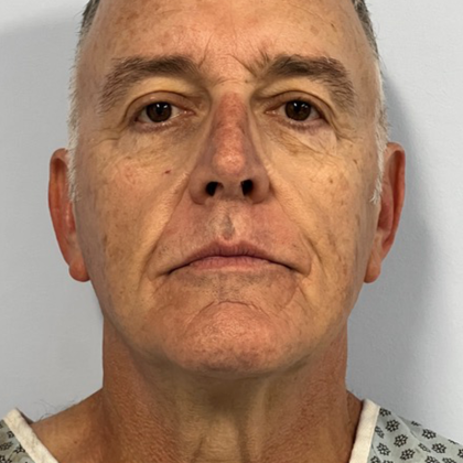 HourLift Before & After Patient #10582