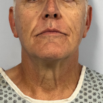 Neck Lift Before & After Patient #10587