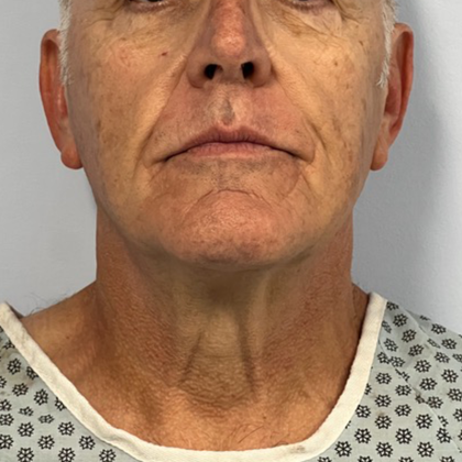 Neck Lift Before & After Patient #10587
