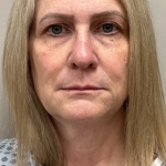 HourLift Before & After Patient #10634