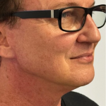 HourLift Before & After Patient #10628