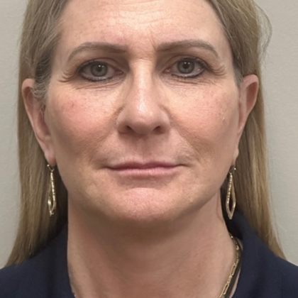 HourLift Before & After Patient #10634