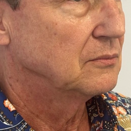 Neck Lift Before & After Patient #10633