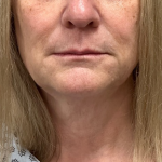 Neck Lift Before & After Patient #10639