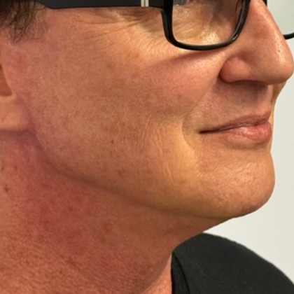 Neck Lift Before & After Patient #10633