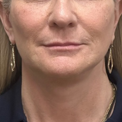 Neck Lift Before & After Patient #10639