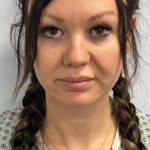 HourLift Before & After Patient #10660