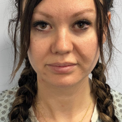HourLift Before & After Patient #10660