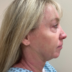 HourLift Before & After Patient #10654
