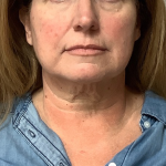 Neck Liposuction Before & After Patient #10705