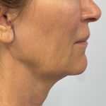 Mini Facelift Before & After Patient #10710
