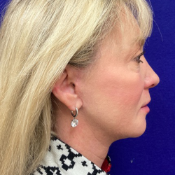HourLift Before & After Patient #10654