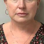 Neck Liposuction Before & After Patient #10705