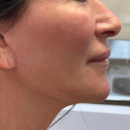 HourLift Before & After Patient #10710
